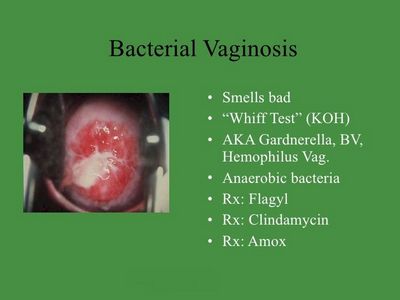 Bacterial Vaginosis - The Causes of the Uncomfortable Smell
