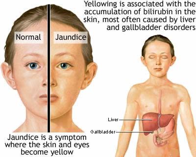 Jaundice in Children