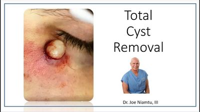 Nodule Removal and Removals