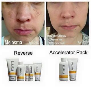 Self-Help Techniques For Getting Rid of Melasma
