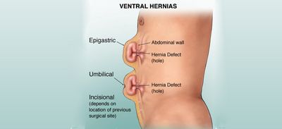 Types of Hernia - Which Type of Hernia Should You See Your Doctor About?
