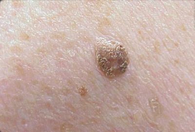 What Does Skin Cancer Look Like?