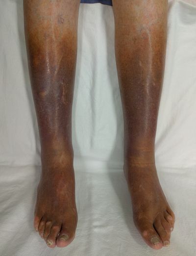 What Is the Best Treatment For Cyanosis?