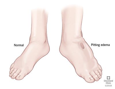 EDema - What is it?