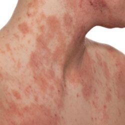 Simple Home Remedies for Eczema